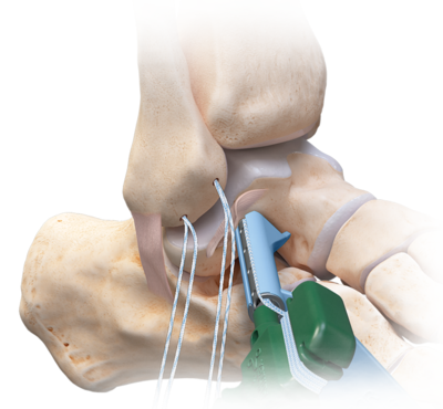 Arthrex - InternalBrace™ Ligament Augmentation Repair—Deltoid Ligament